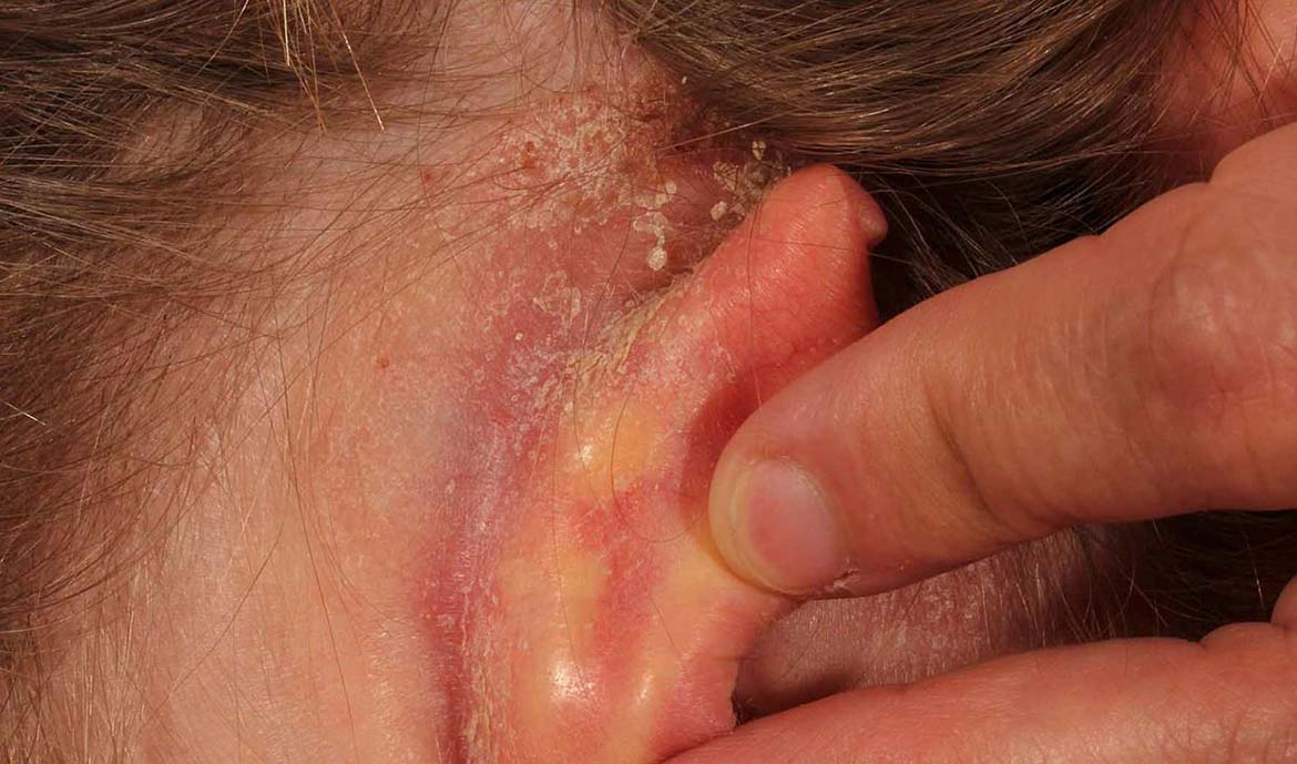 Ear Eczema - Association of Australasia