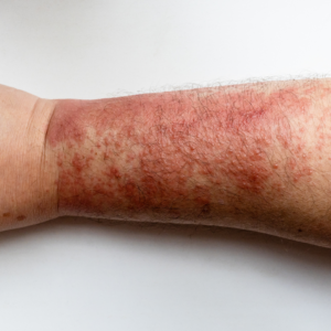 Person experiencing contact dermatitis on hands with dry, irritated skin